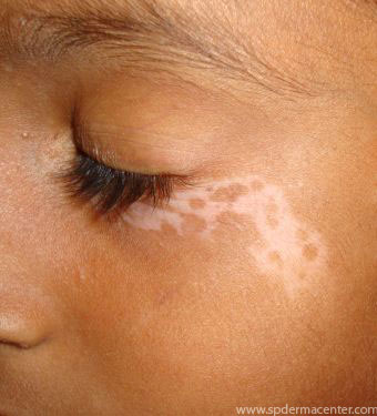 Vitiligo-Before